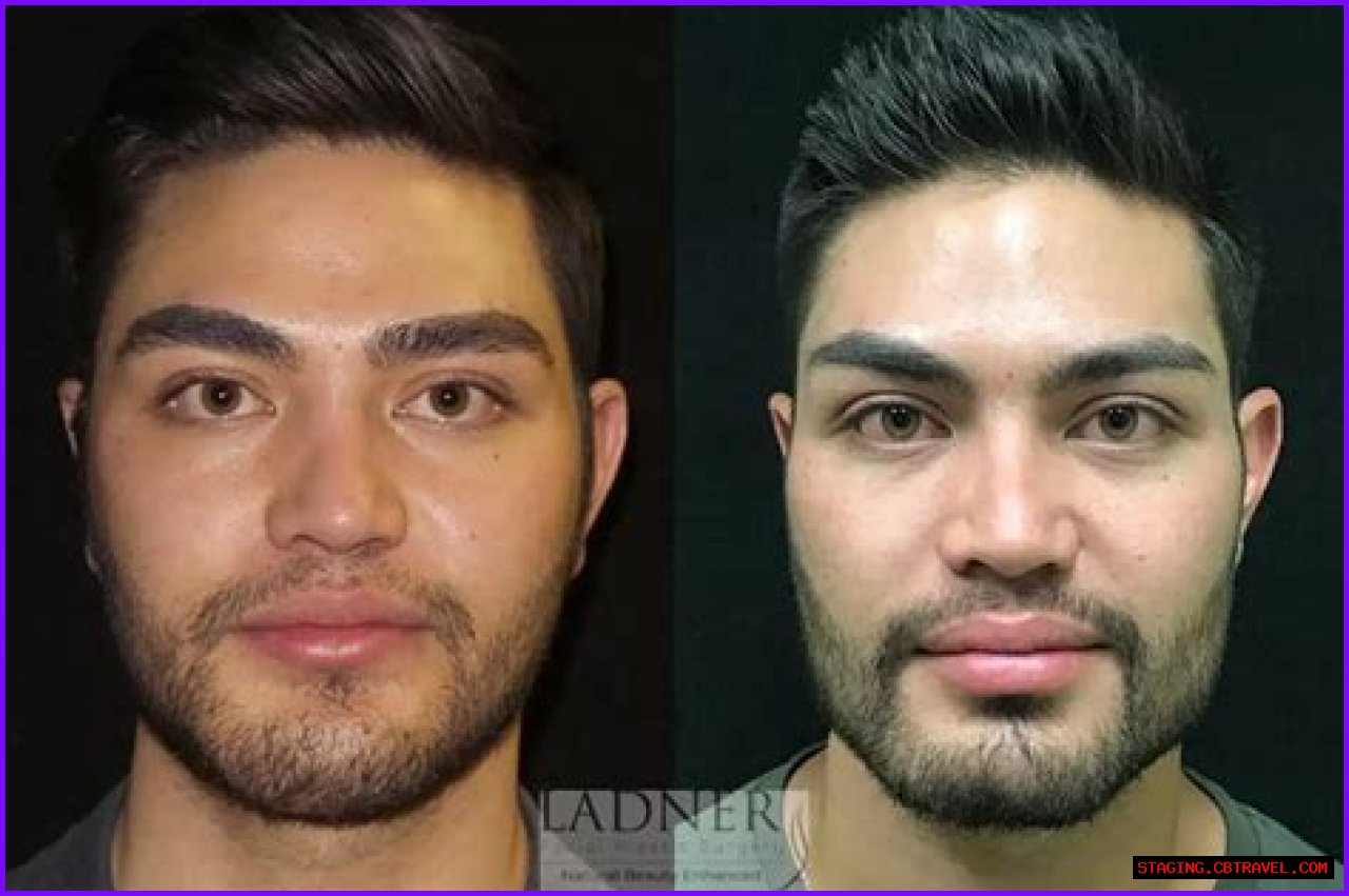 Unveiling The Transformation: Sophie Turner And Buccal Fat Removal